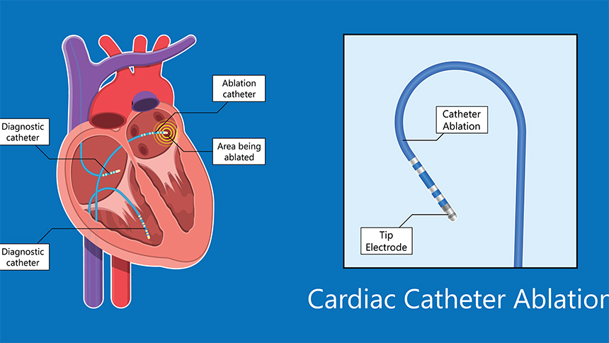 Cardiac Catheter Ablation