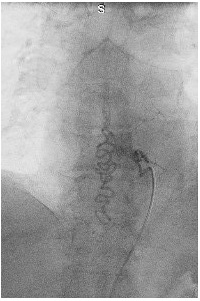 spinal angiogram