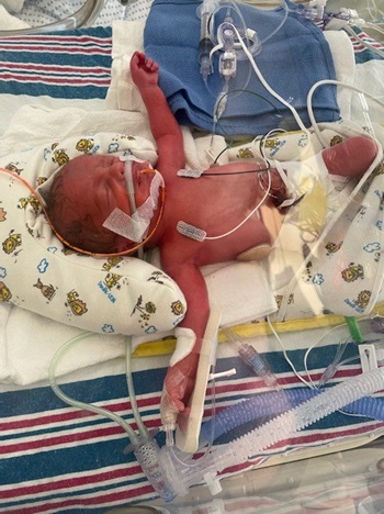 Premature baby in incubator on oxygen