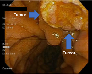 Endoscopic ultrasound revealed a small tumor