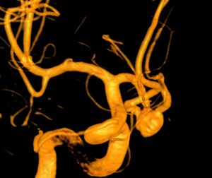 3D view of Matt’s brain aneurysm from the biplane angiography system