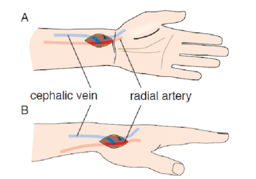 Vascular access for renal dialysis