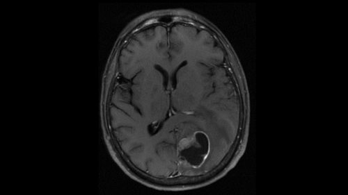 Jayne Davis Pre Op MRI Web