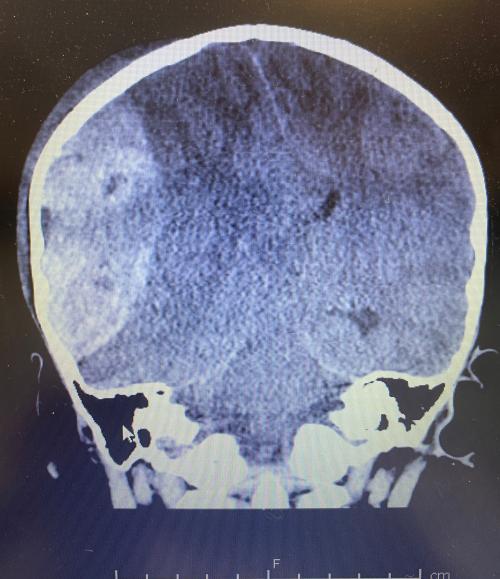 Pediatric Head Injury Patient 1