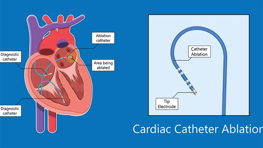 Article - catheter-heart