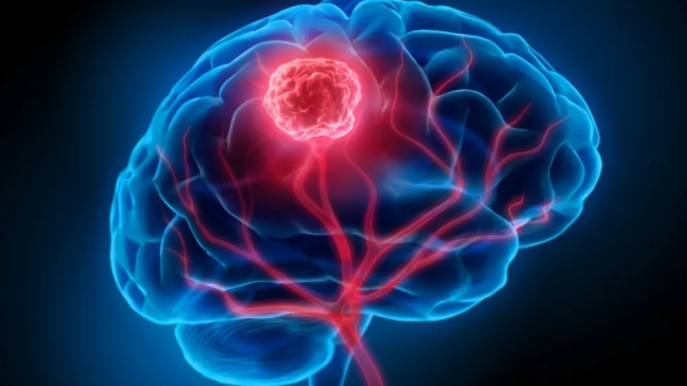 Hero New Glioblastoma Surgical Technique at VBMC