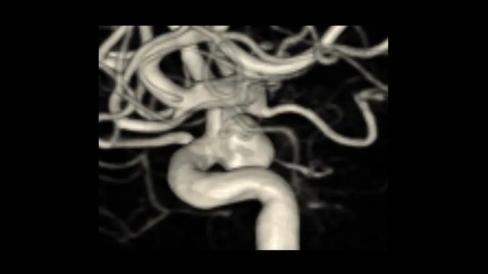 Milton Reyman 3D aneurysm